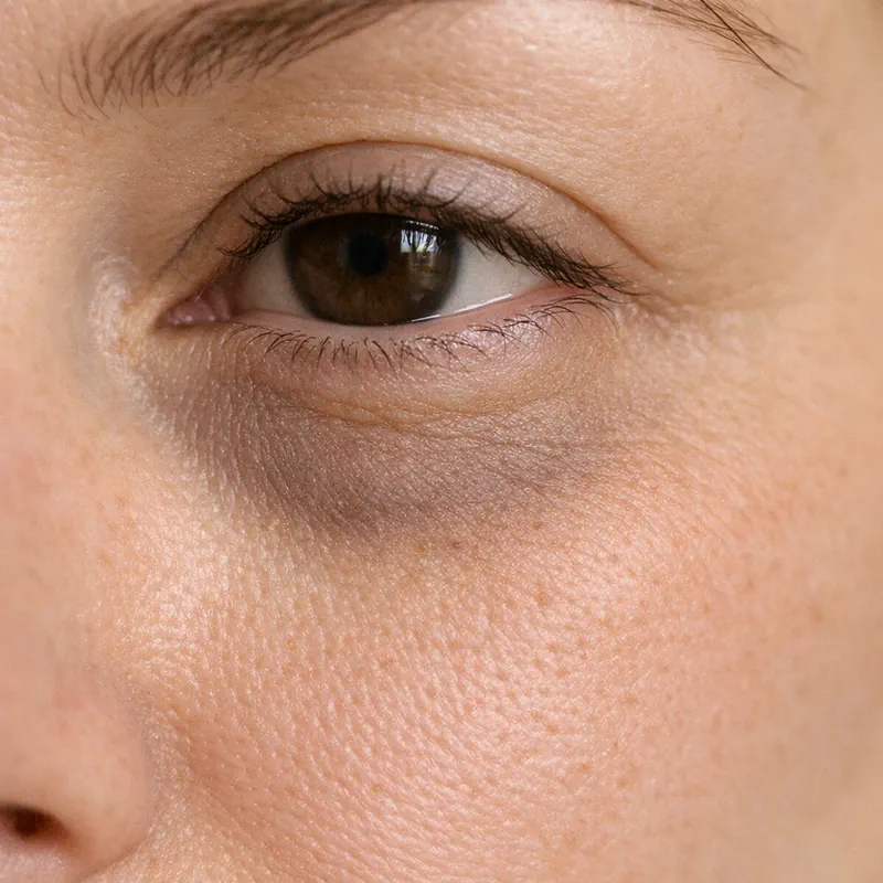 Pigmentary dark circle